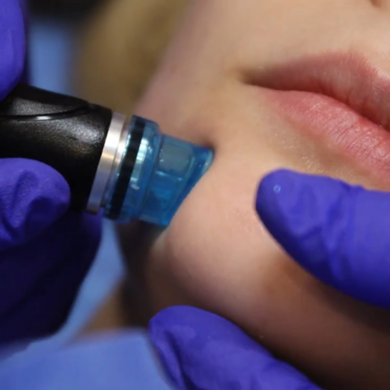 hydrafacial en hermosillo sonora méxico